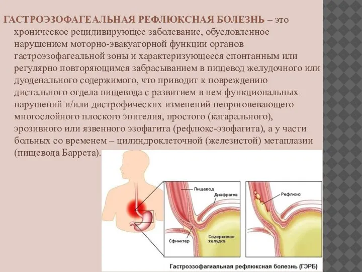 ГАСТРОЭЗОФАГЕАЛЬНАЯ РЕФЛЮКСНАЯ БОЛЕЗНЬ – это хроническое рецидивирующее заболевание, обусловленное нарушением моторно-эвакуаторной функции