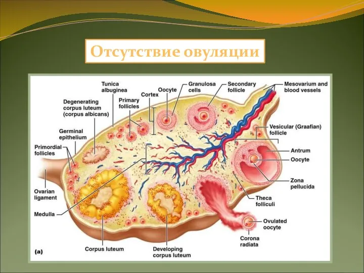 Отсутствие овуляции