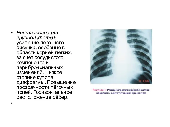 Рентгенография грудной клетки: усиление легочного рисунка, осо­бенно в области корней легких, за