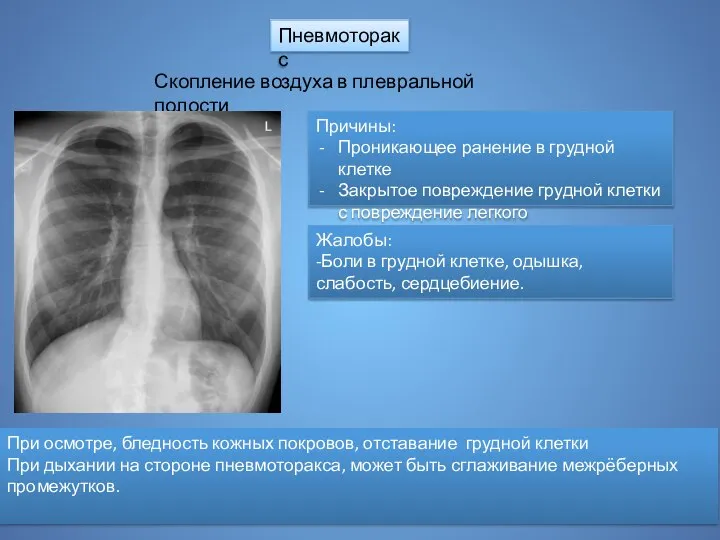 Пневмоторакс Скопление воздуха в плевральной полости Причины: Проникающее ранение в грудной клетке