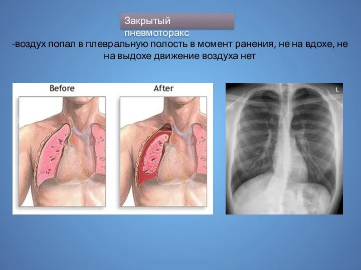 Закрытый пневмоторакс -воздух попал в плевральную полость в момент ранения, не на