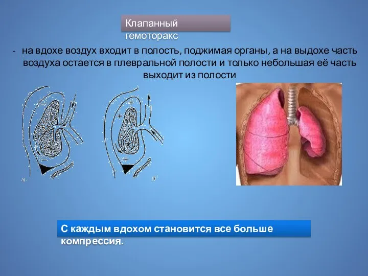 Клапанный гемоторакс на вдохе воздух входит в полость, поджимая органы, а на