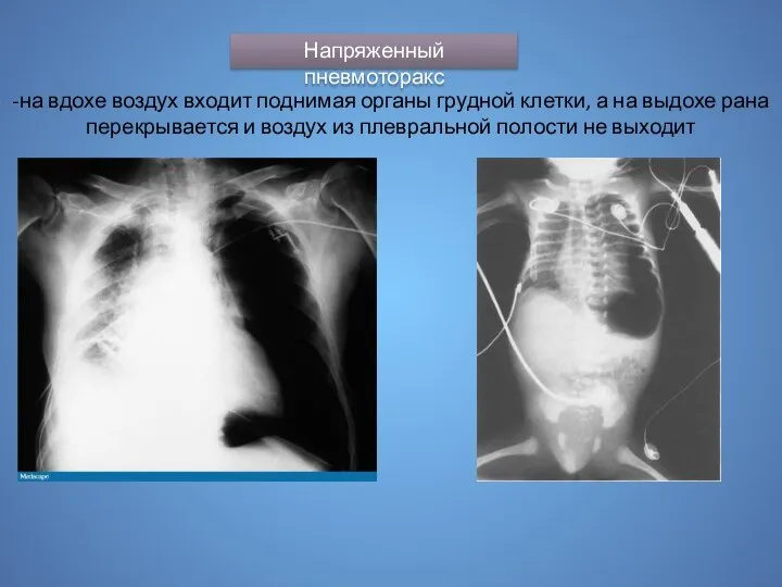 Напряженный пневмоторакс -на вдохе воздух входит поднимая органы грудной клетки, а на