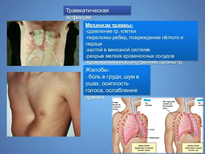 Травматическая асфиксия Механизм травмы: -сдавление гр. клетки -переломы ребер, повреждение лёгкого и