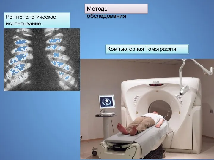 Методы обследования Рентгенологическое исследование Компьютерная Томография