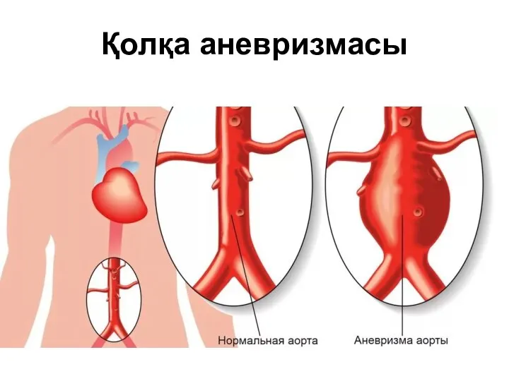 Қолқа аневризмасы