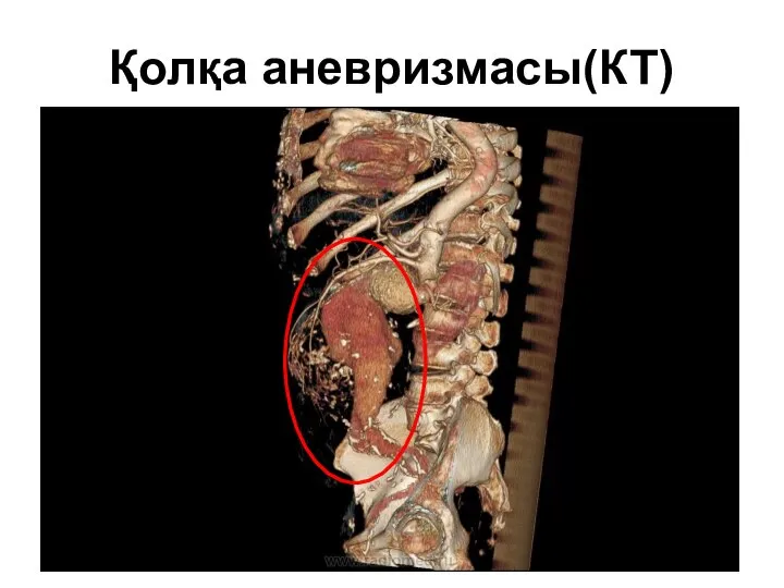 Қолқа аневризмасы(КТ)