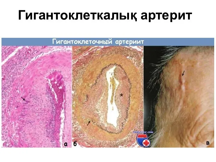 Гигантоклеткалық артерит