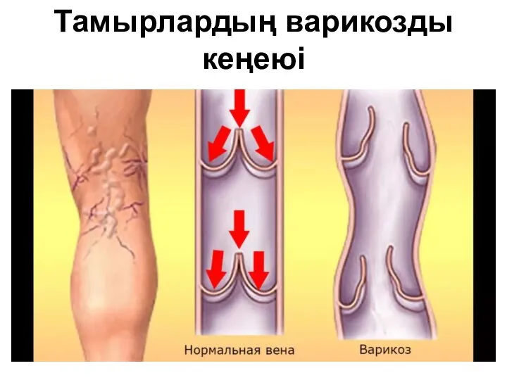 Тамырлардың варикозды кеңеюі