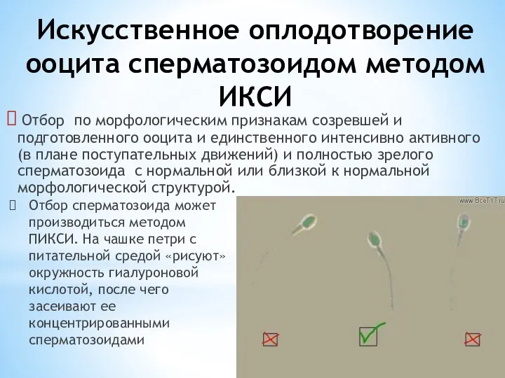 Искусственное оплодотворение ооцита сперматозоидом методом ИКСИ Отбор по морфологическим признакам созревшей и