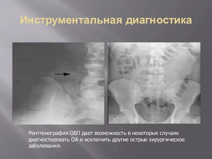 Инструментальная диагностика Рентгенография ОБП дает возможность в некоторых случаях диагностировать ОА и