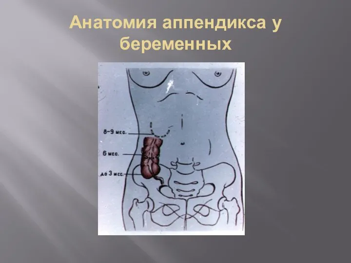 Анатомия аппендикса у беременных
