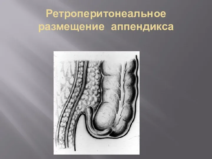 Ретроперитонеальное размещение аппендикса