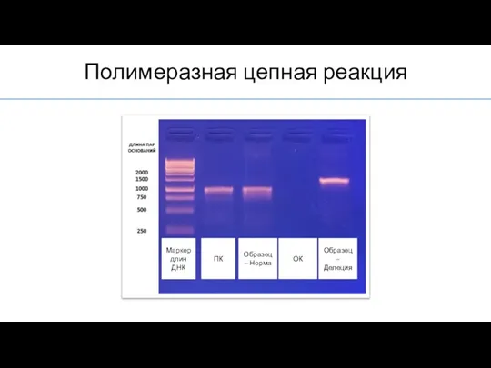 Полимеразная цепная реакция Маркер длин ДНК ПК Образец – Норма ОК Образец – Делеция