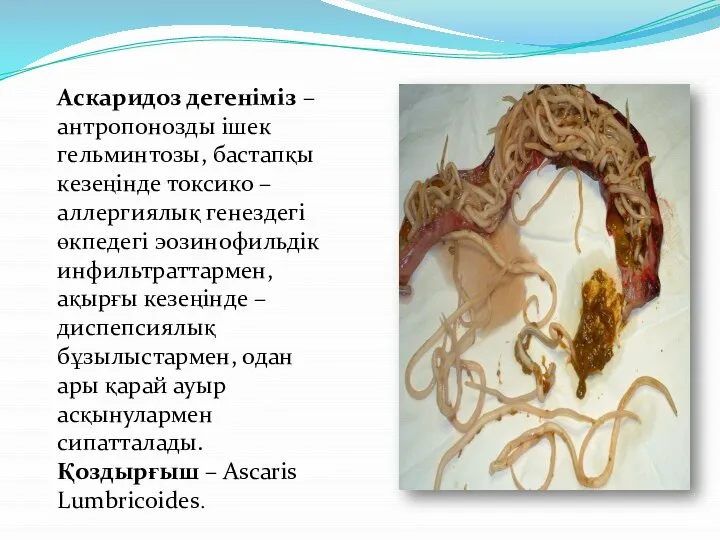 Аскаридоз дегеніміз – антропонозды ішек гельминтозы, бастапқы кезеңінде токсико – аллергиялық генездегі