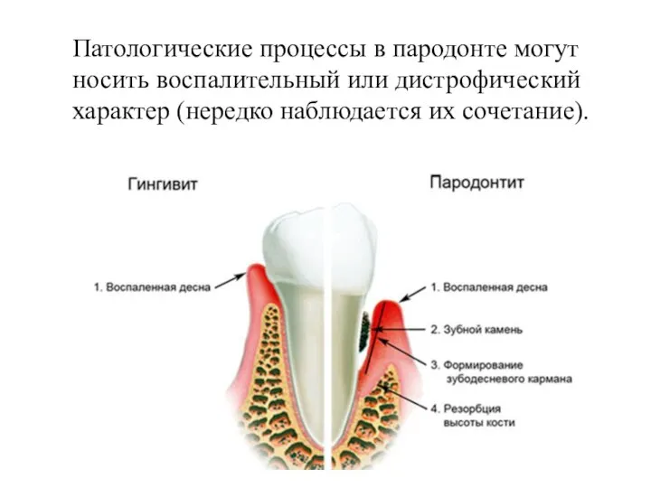 Патологические процессы в пародонте могут носить воспалительный или дистрофический характер (нередко наблюдается их сочетание).