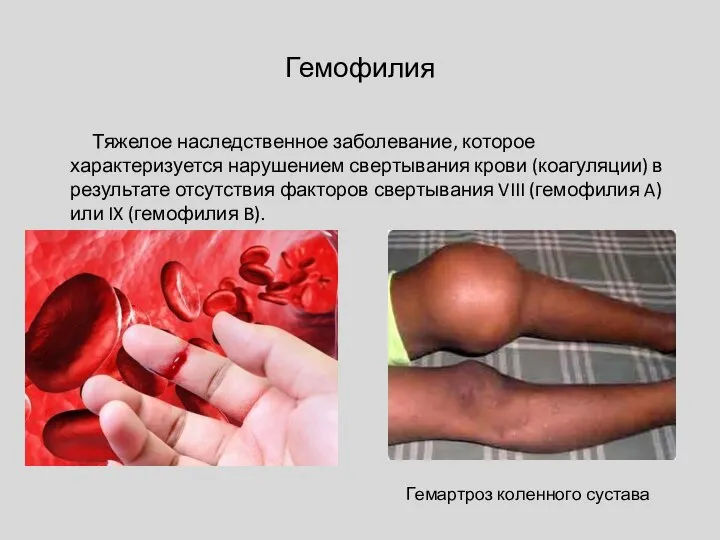 Гемофилия Тяжелое наследственное заболевание, которое характеризуется нарушением свертывания крови (коагуляции) в результате