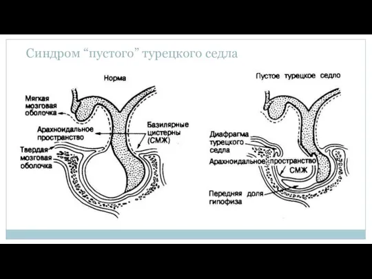 Синдром “пустого” турецкого седла