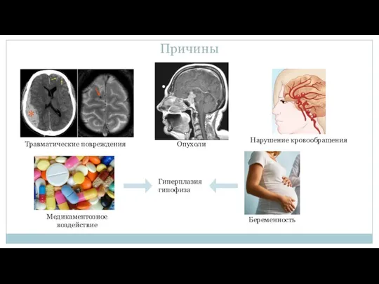 Причины Опухоли Травматические повреждения Нарушение кровообращения Медикаментозное воздействие Беременность Гиперплазия гипофиза