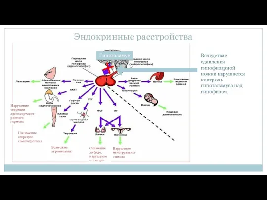 Эндокринные расстройства Гипоталамус Нарушение менструального цикла Вследствие сдавления гипофизарной ножки нарушается контроль