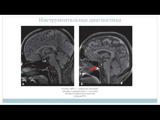 Инструментальная диагностика Результат МРТ: a – нормальное положение гипофиза в турецком седле;