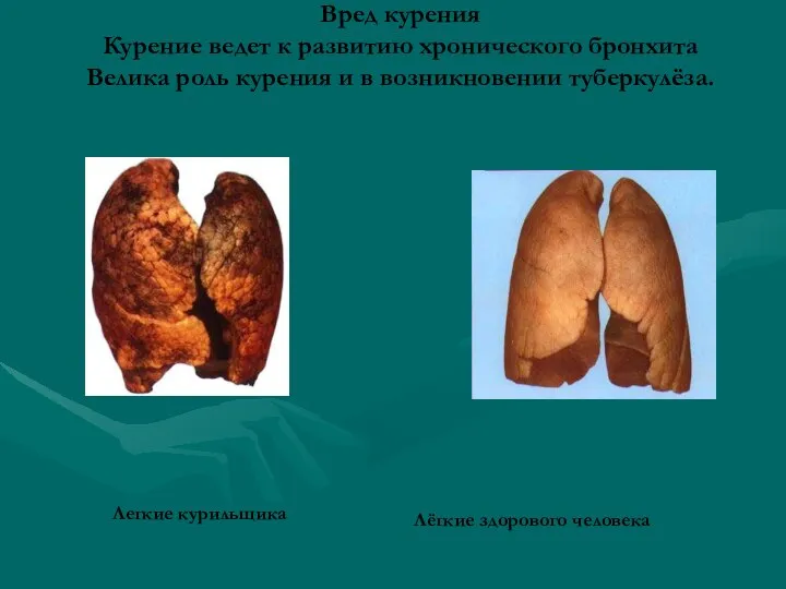 Вред курения Курение ведет к развитию хронического бронхита Велика роль курения и