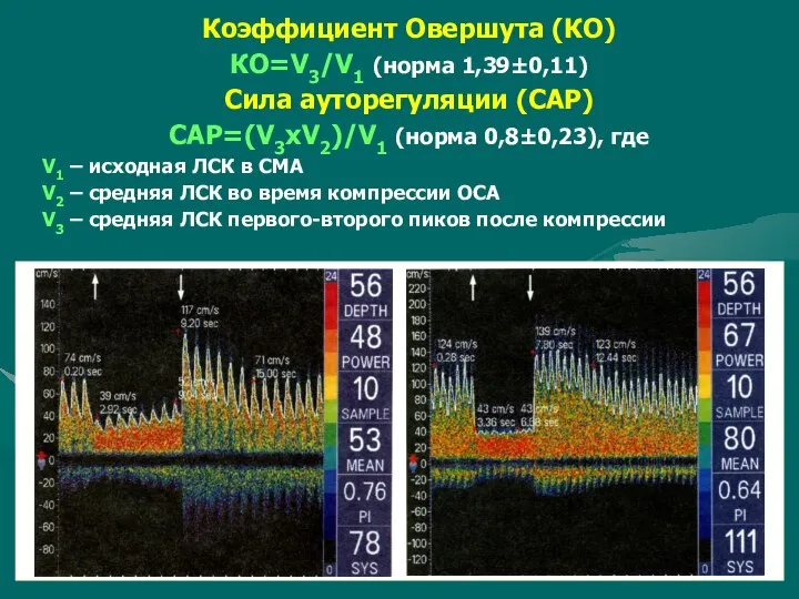 Коэффициент Овершута (КО) КО=V3/V1 (норма 1,39±0,11) Сила ауторегуляции (САР) САР=(V3xV2)/V1 (норма 0,8±0,23),