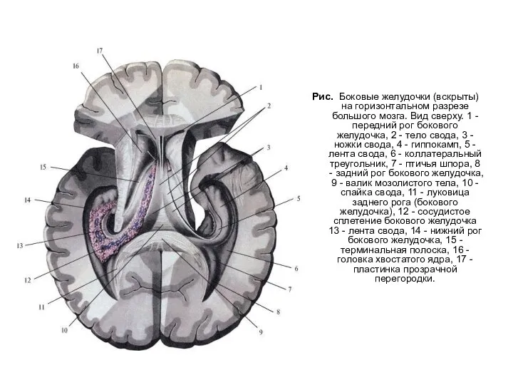 Рис. Боковые желудочки (вскрыты) на горизонтальном разрезе большого мозга. Вид сверху. 1