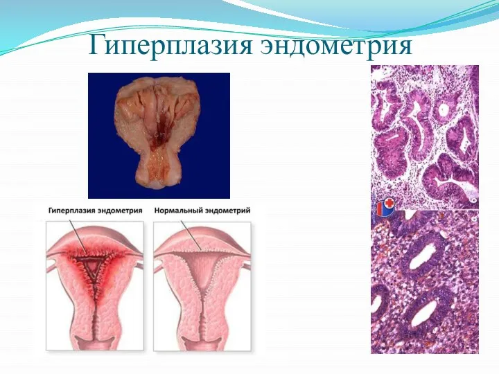 Гиперплазия эндометрия