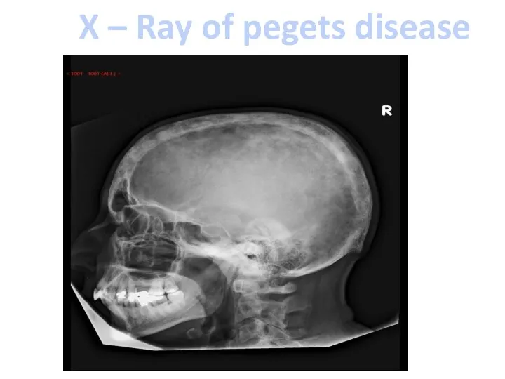 X – Ray of pegets disease