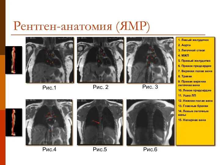 Рентген-анатомия (ЯМР) 1. Левый желудочек 2. Аорта 3. Легочной ствол 4. МЖП