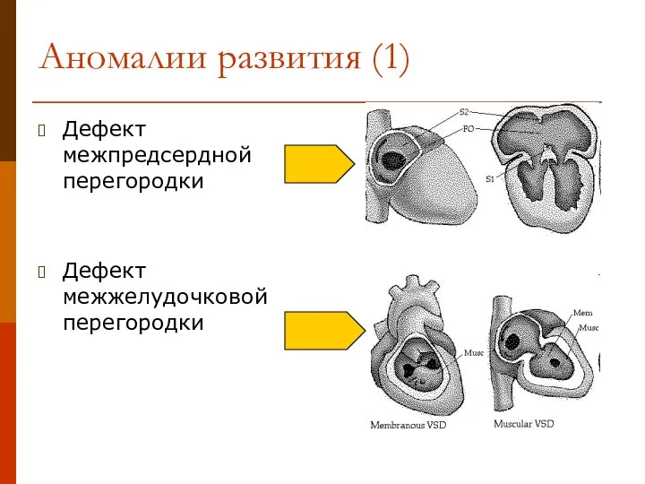 Аномалии развития (1) Дефект межпредсердной перегородки Дефект межжелудочковой перегородки