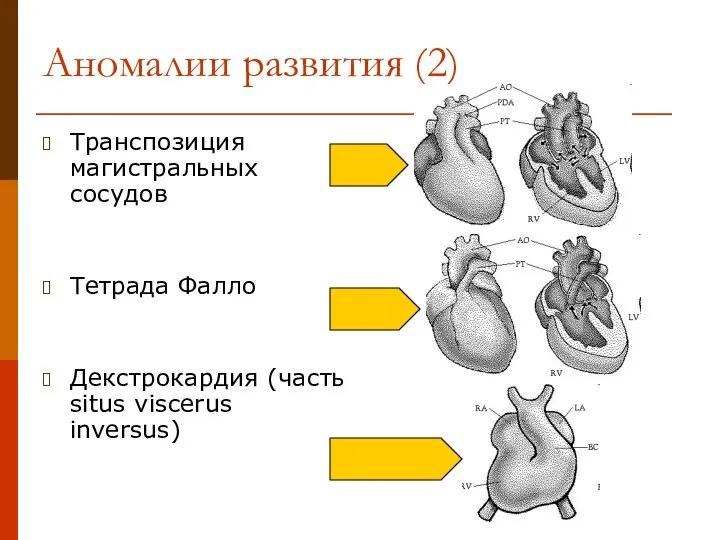 Аномалии развития (2) Транспозиция магистральных сосудов Тетрада Фалло Декстрокардия (часть situs viscerus inversus)