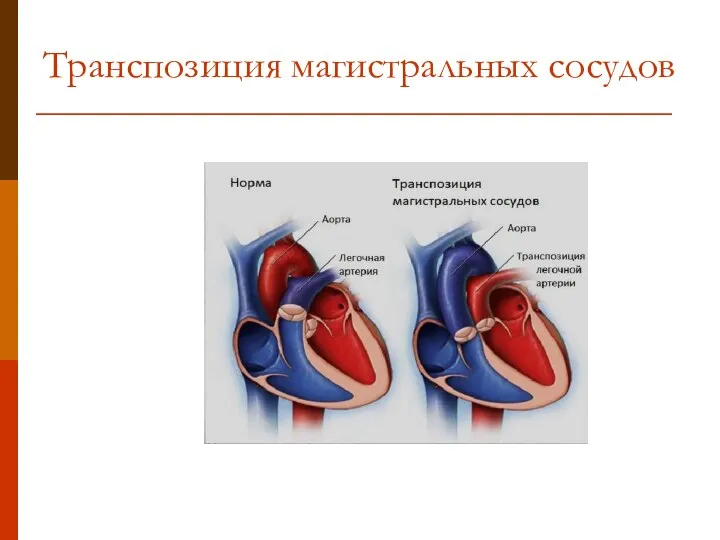 Транспозиция магистральных сосудов