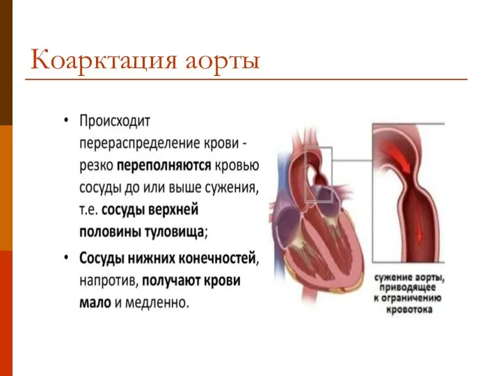 Коарктация аорты