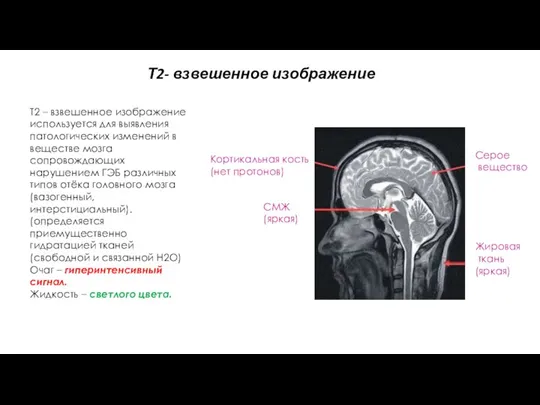 Т2 – взвешенное изображение используется для выявления патологических изменений в веществе мозга