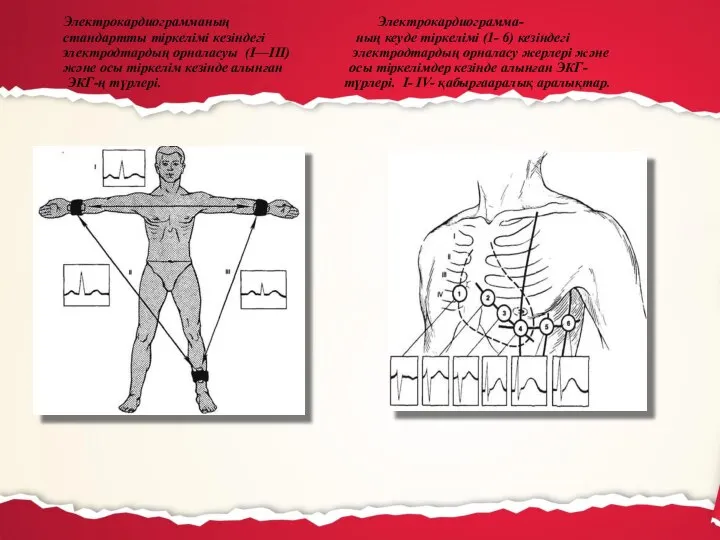 Электрокардиограмманың Электрокардиограмма- стандартты тіркелімі кезіндегі ның кеуде тіркелімі (1- 6) кезіндегі электродтардың