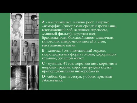 А - маленький вес, низкий рост, лицевые дизморфии (гипоплазия средней трети лица,