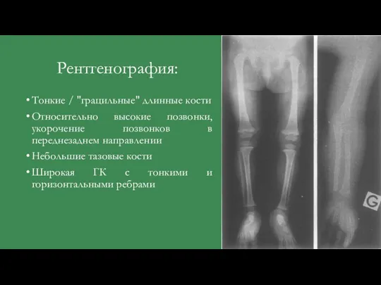 Рентгенография: Тонкие / "грацильные" длинные кости Относительно высокие позвонки, укорочение позвонков в