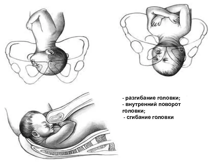 - разгибание головки; - внутренний поворот головки; - сгибание головки