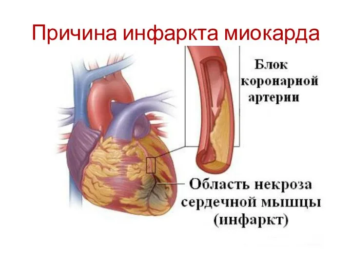 Причина инфаркта миокарда