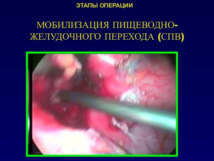 МОБИЛИЗАЦИЯ ПИЩЕВОДНО-ЖЕЛУДОЧНОГО ПЕРЕХОДА (СПВ) ЭТАПЫ ОПЕРАЦИИ