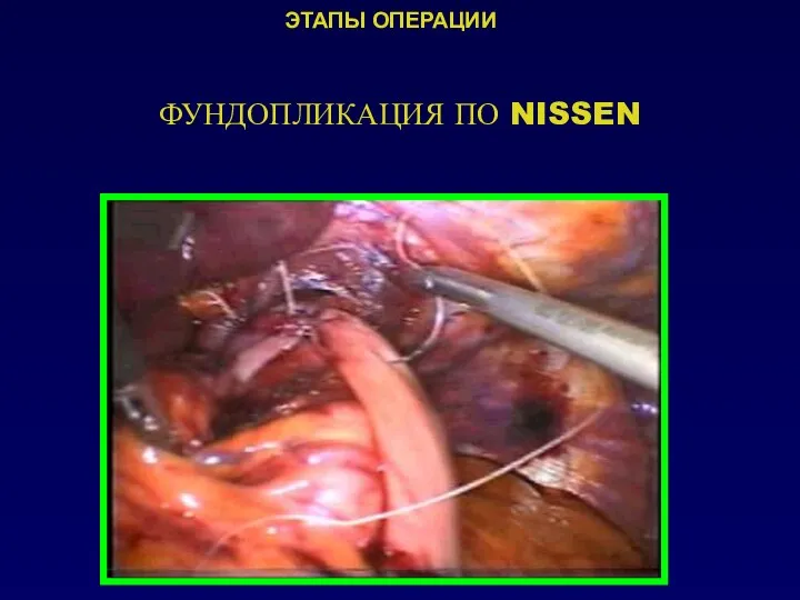 ФУНДОПЛИКАЦИЯ ПО NISSEN ЭТАПЫ ОПЕРАЦИИ