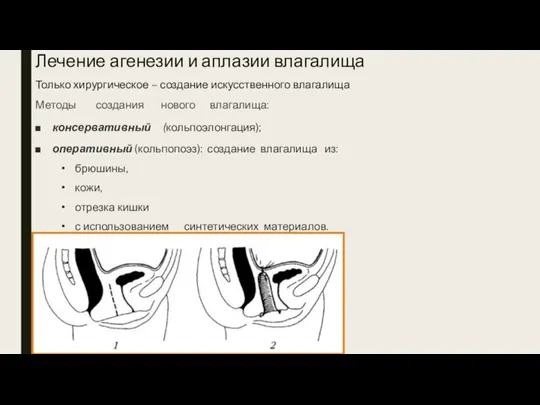 Лечение агенезии и аплазии влагалища Только хирургическое – создание искусственного влагалища Методы