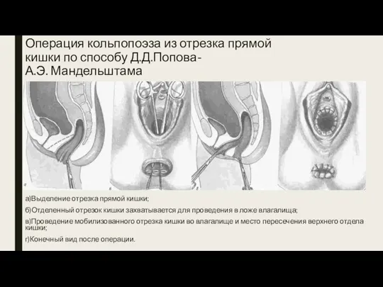 Операция кольпопоэза из отрезка прямой кишки по способу Д.Д.Попова- А.Э. Мандельштама а)Выделение