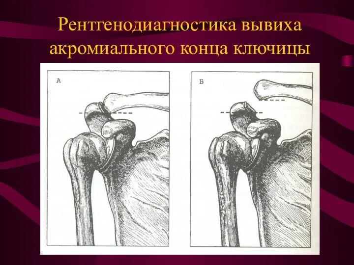 Рентгенодиагностика вывиха акромиального конца ключицы