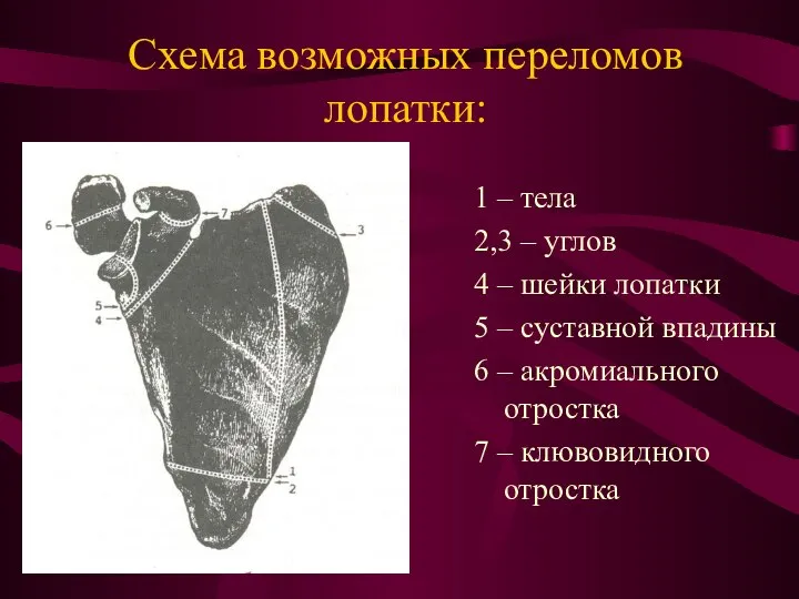 Схема возможных переломов лопатки: 1 – тела 2,3 – углов 4 –