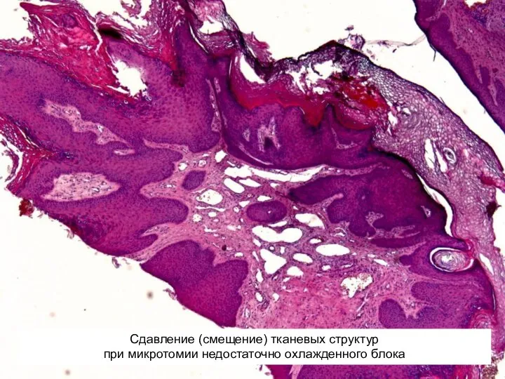 Сдавление (смещение) тканевых структур при микротомии недостаточно охлажденного блока