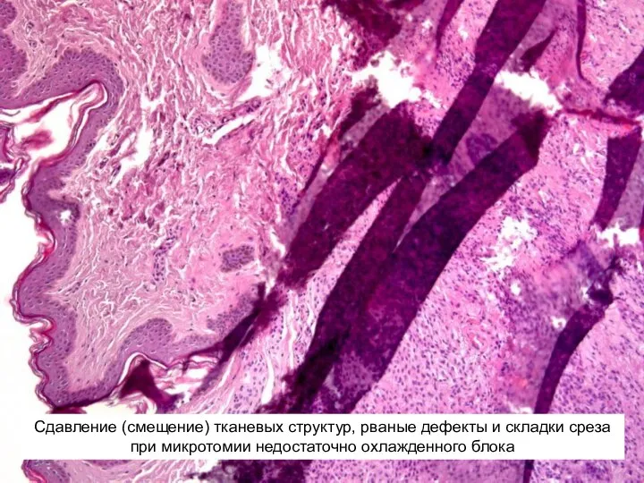 Сдавление (смещение) тканевых структур, рваные дефекты и складки среза при микротомии недостаточно охлажденного блока