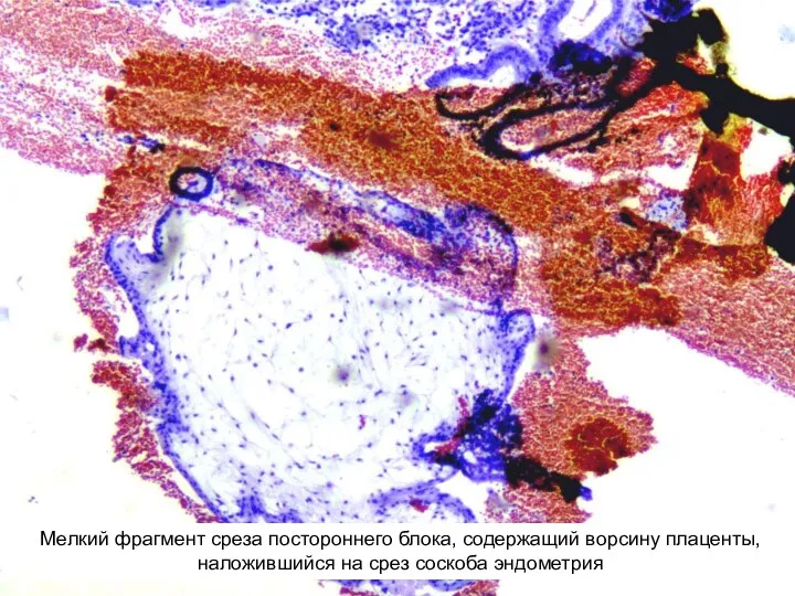 Мелкий фрагмент среза постороннего блока, содержащий ворсину плаценты, наложившийся на срез соскоба эндометрия